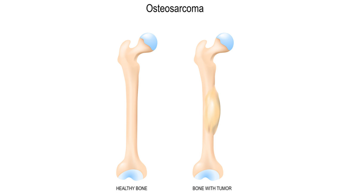 strankycinskemediciny-osteosarkom
